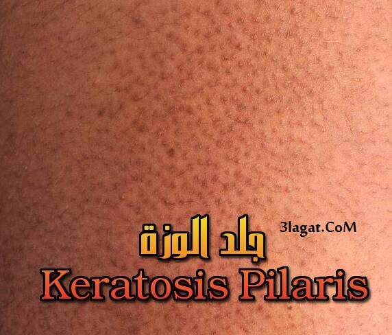 Keratosis Pilaris جلد الوزة جلد الدجاجة